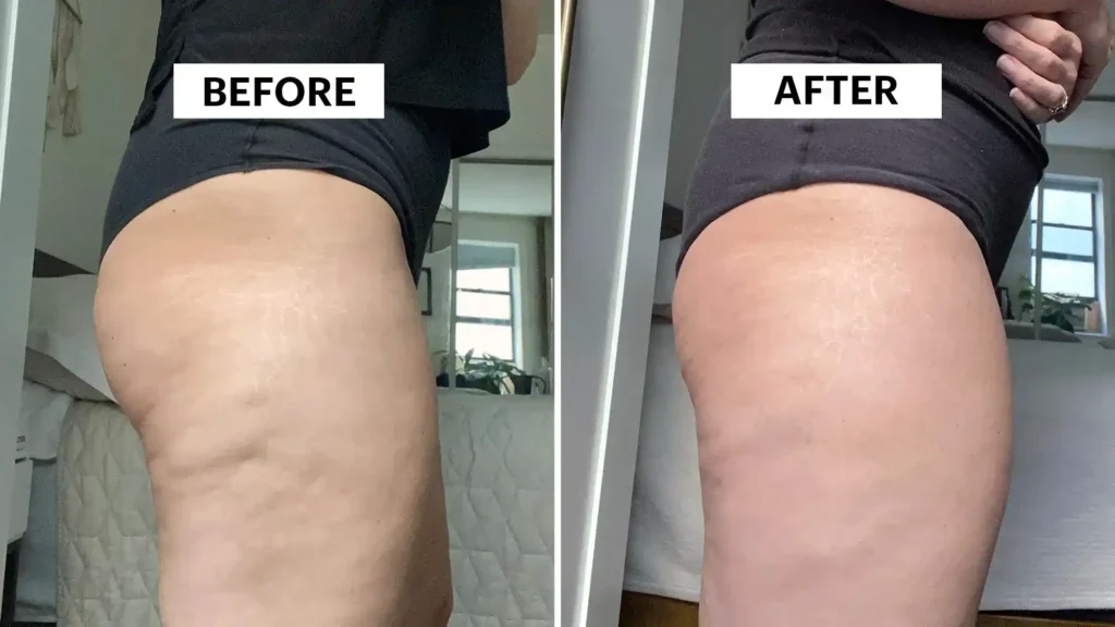 Sculpting Your Bum: Can Toning Exercises Really Reduce Cellulite? 1 Do Toning Exercise Birch Really Tackle Cellulite?
