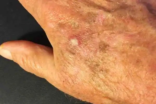 Cryopen For Actinic Keratoses 1 Image of Actinic keratoses Birch on a person hand