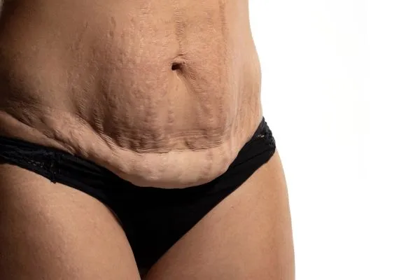 The Science of Skin Tightening 1 The science behind skin tightening Birch picture of a woman's sagging skin on the stomach